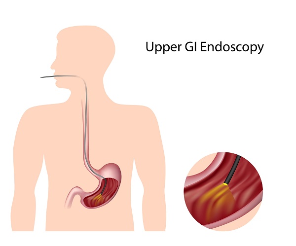 Gastrointestinal Reflux Disease